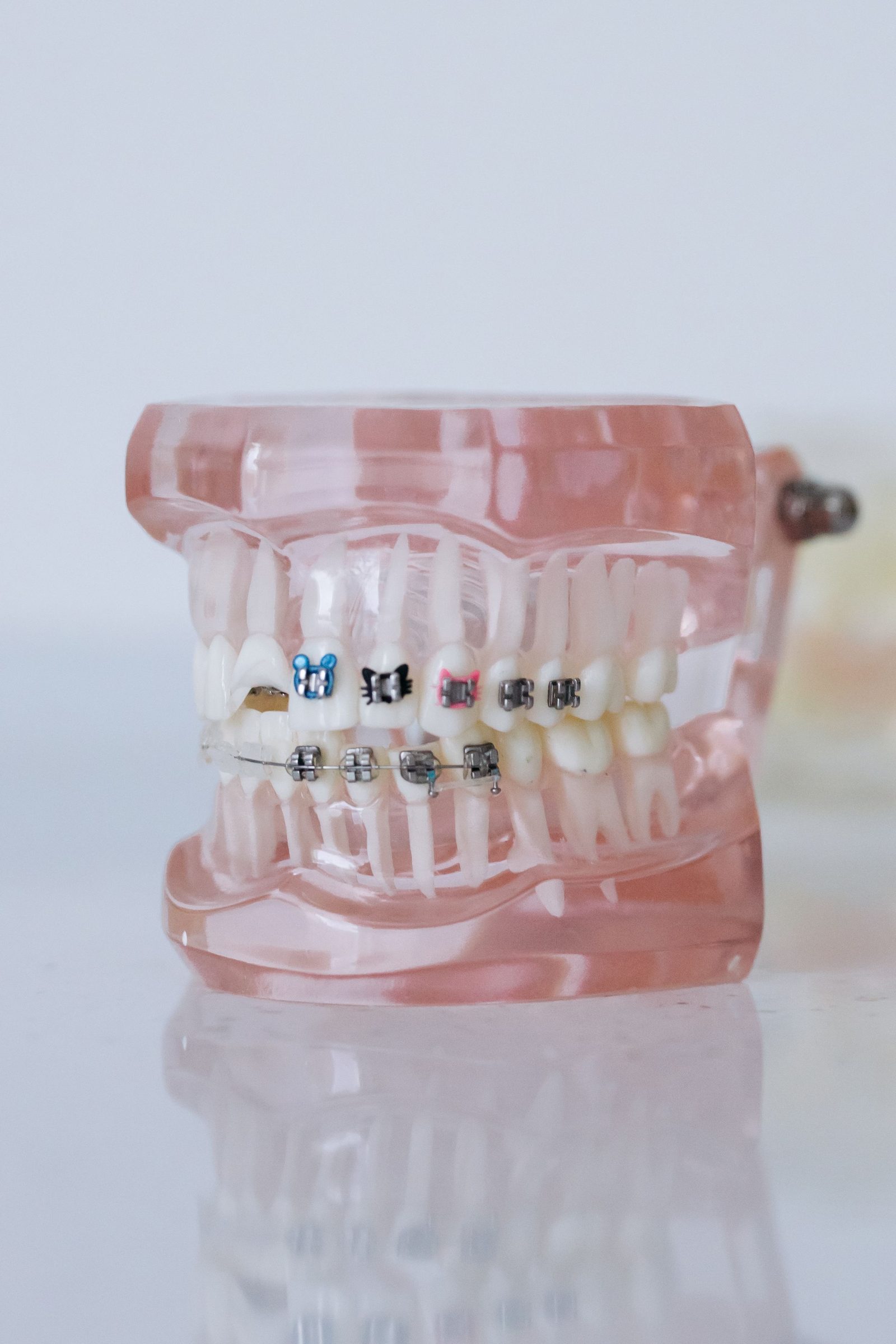 Gambar rapat braces logam pada gigi