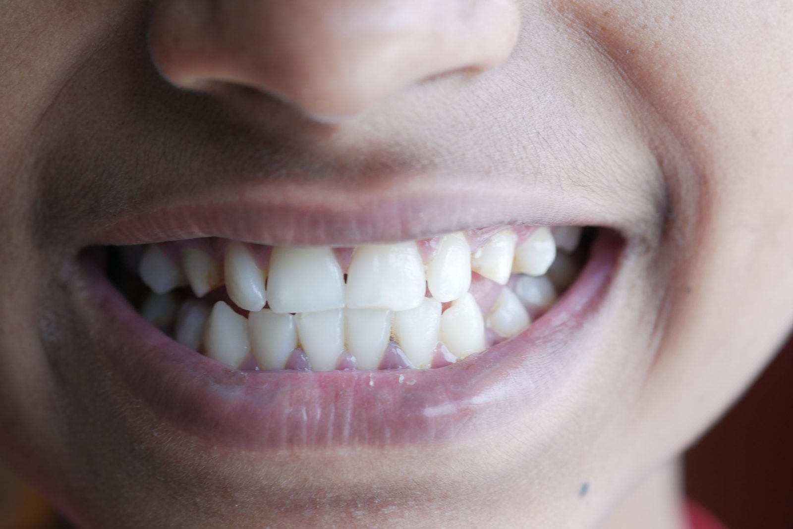 Orang dewasa tersenyum semasa rawatan braces